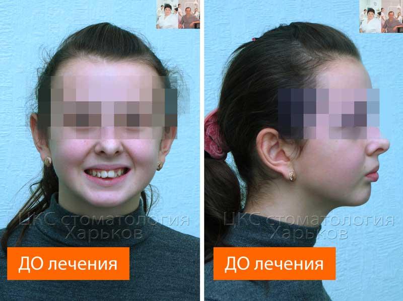 обследование строения лица до брекетов
