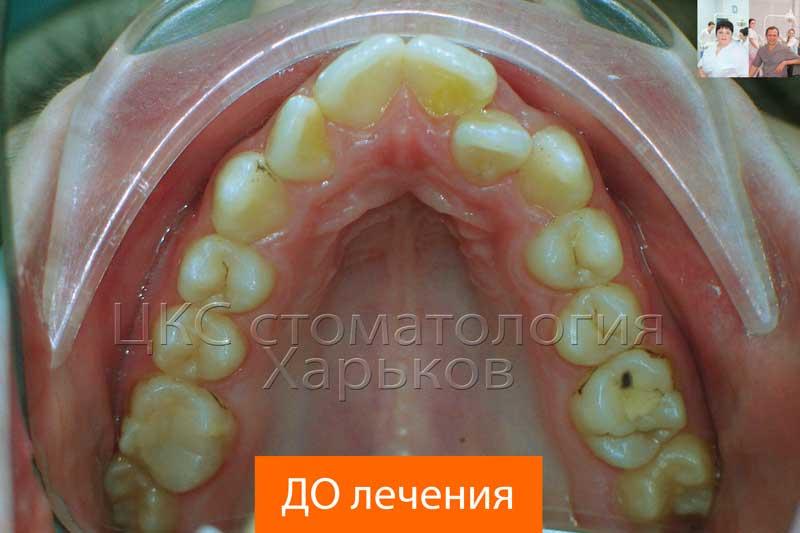 Обследование зубных рядов до установки брекет системы