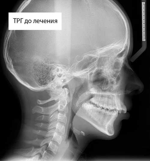 Расчет рентгеновского снимка ТРГ