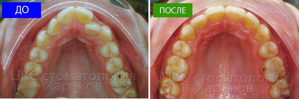 Форма зубного ряда до и после