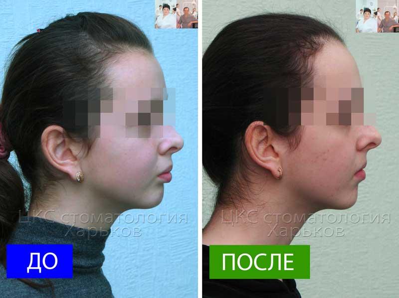 Профиль ДО и ПОСЛЕ