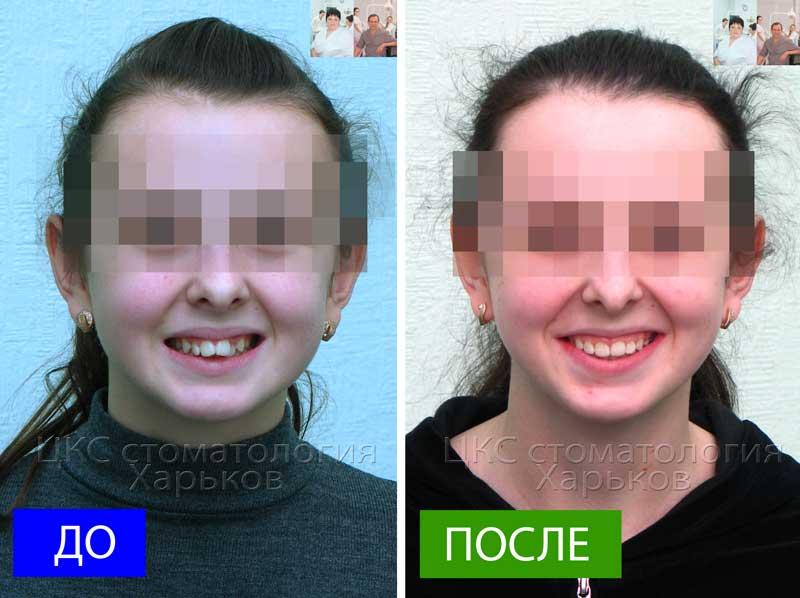Улыбка ДО и ПОСЛЕ