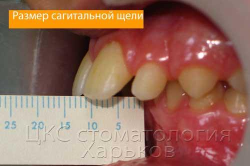 межрезцовая щель зубоальвеолярная форма