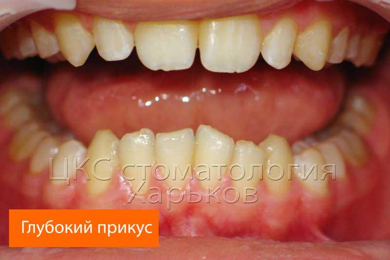 Осложнение глубоким резцовым перекрытием