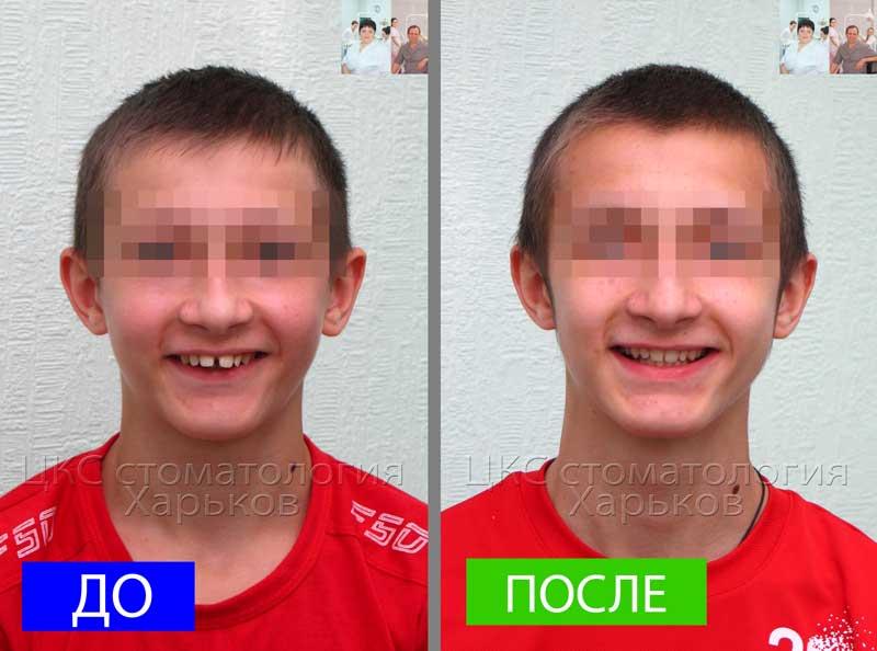 Улыбка ДО и ПОСЛЕ