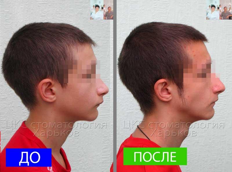 Пропорции лица ДО и ПОСЛЕ