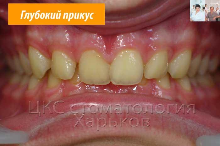 Фронтальное фото зубов до лечения