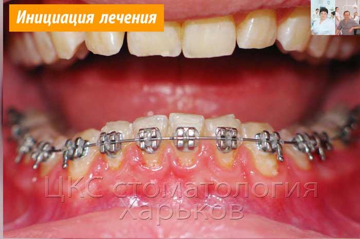 Фото после установки брекет системы