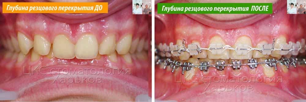 Нормализация резцового перекрытия