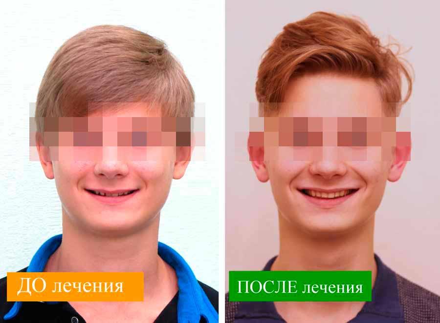 Овал лица и улыбка ДО и ПОСЛЕ