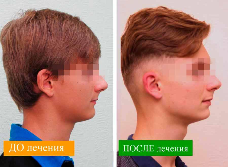 Лицо профиль ДО и ПОСЛЕ