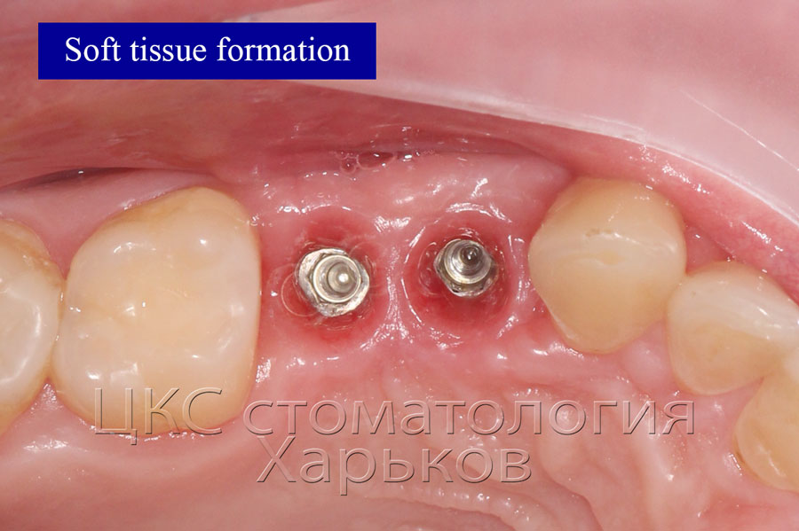 soft tissue formation