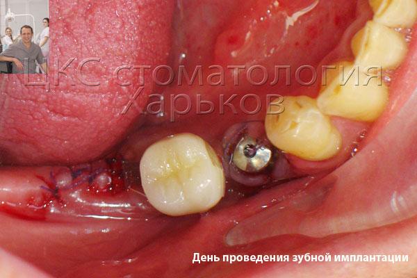 после установки зубных имплантов 
