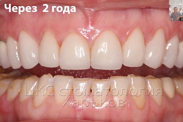 керамические виниры через 2 года фото