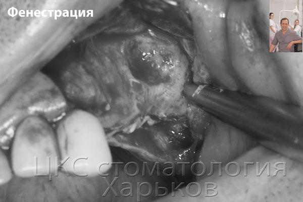 кортикотомия при синус лифтинге