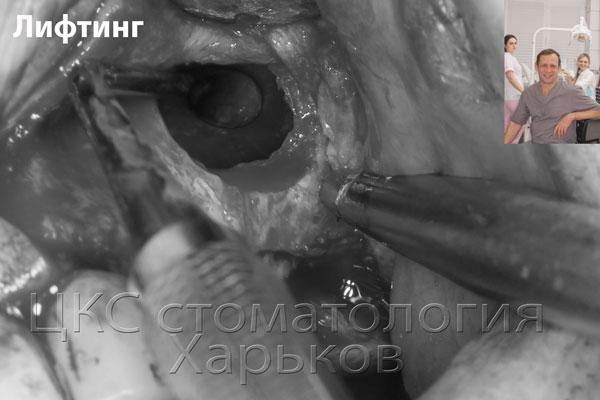 Поднятие слизистой гайморовой пазухи