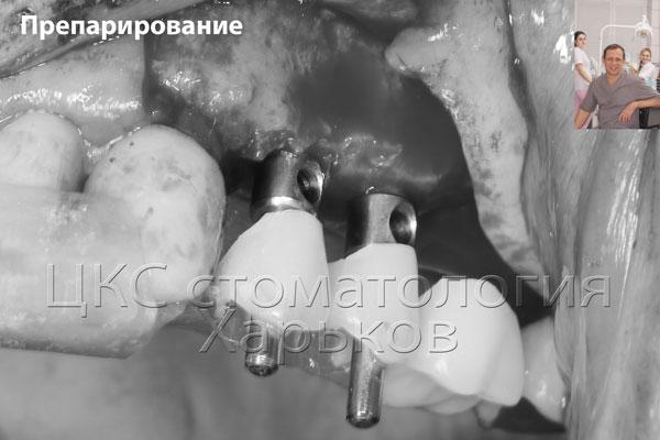 Установка имплантатов при помощи хирургического шаблона