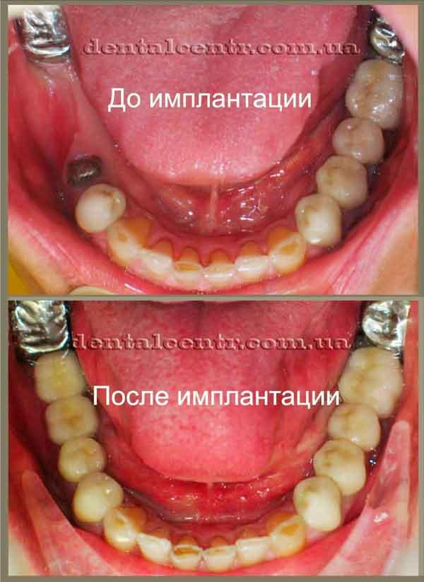 До и после имплантации Фотография до и после имлантации зубов