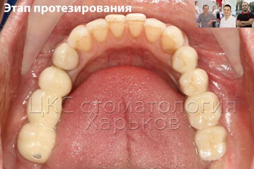 Установка три искусственных зуба импланта