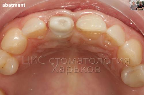 Фото абатмента из диоксида циркония