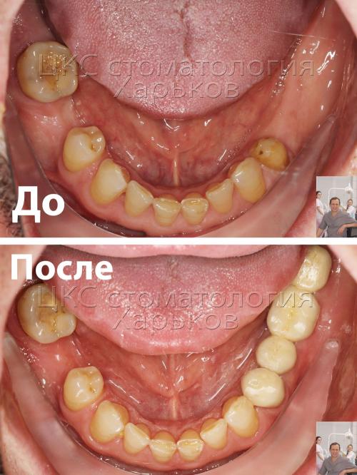 До и после лечения – нижний зубной ряд Нижний зубной ряд до и после лечения