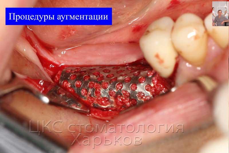 Направленная костная регенерация кости