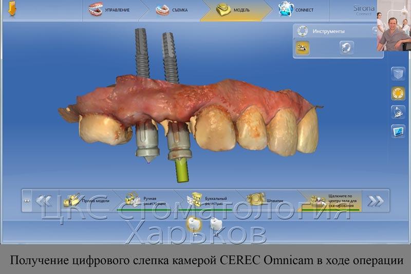 получение слепка в ходе операции