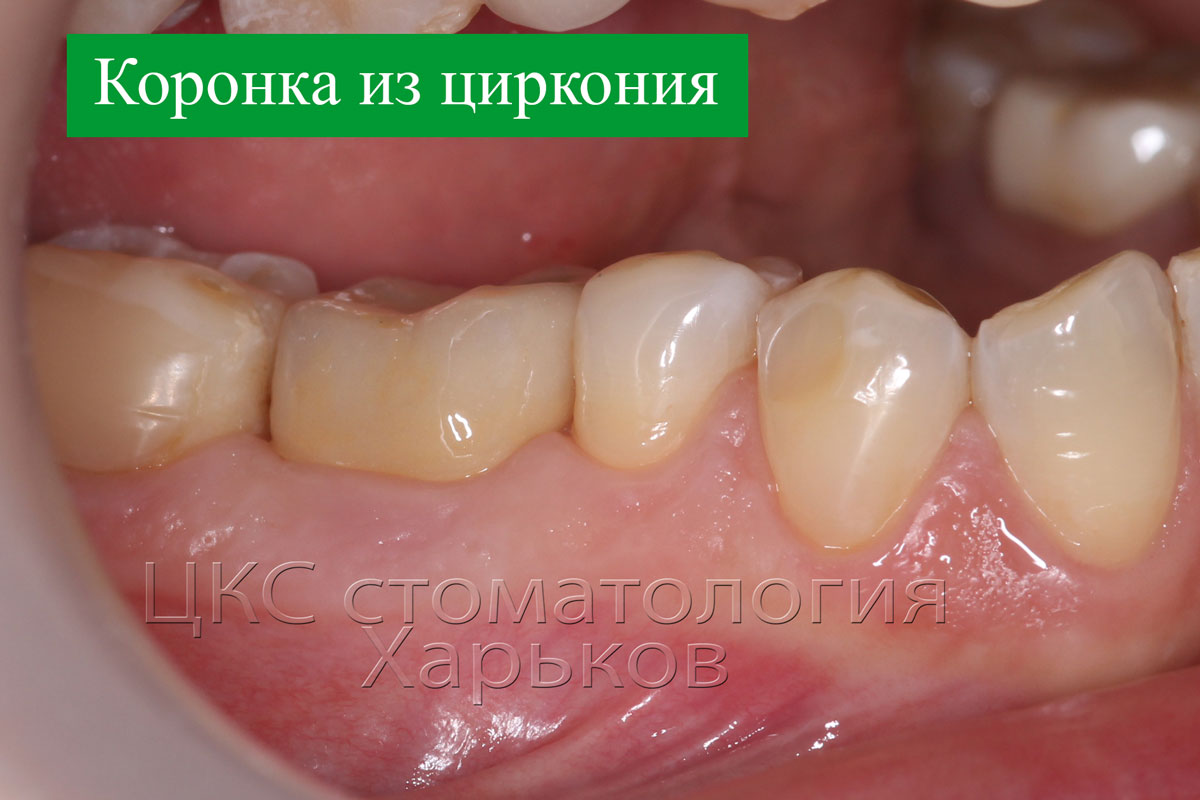 Коронка из циркония на зубном импланте