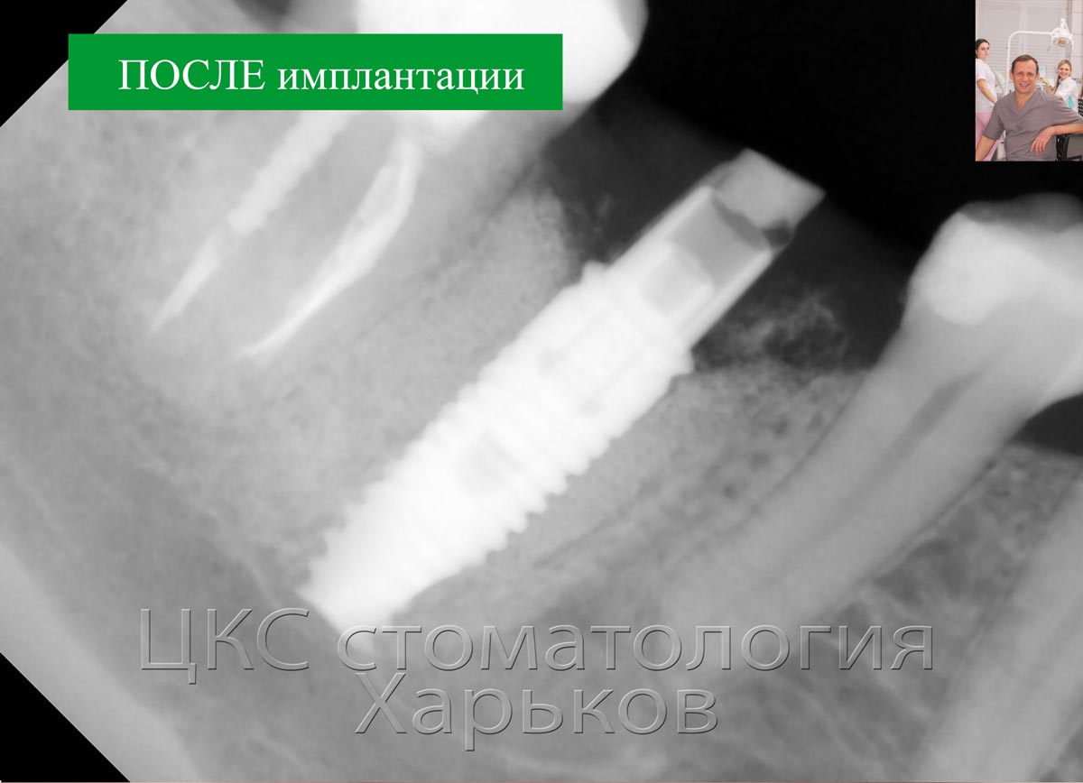 Рентгенограмма после проведения немедленной имплантации