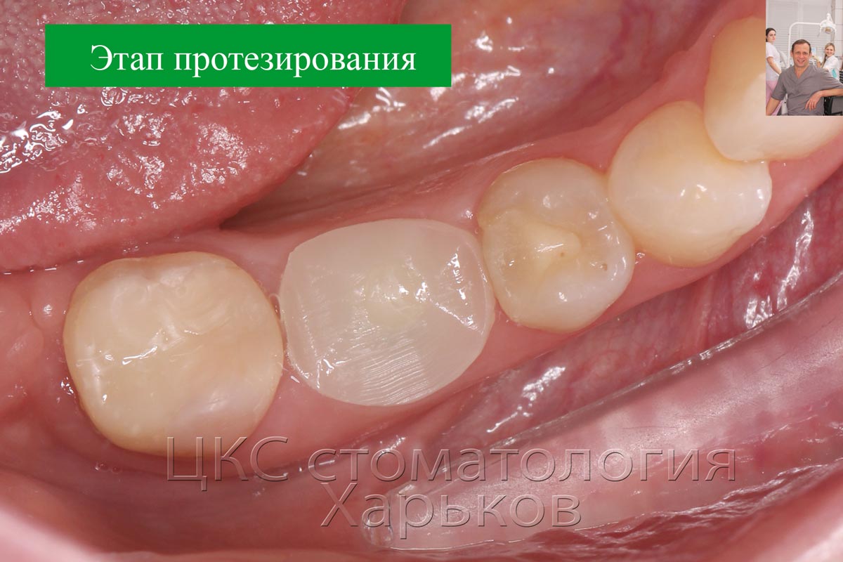 Фото после завершения процесса приживления имплантата