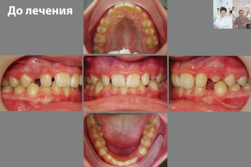 Прикус ДО лечения брекетами, фото