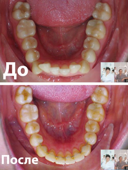 Фото верхней челюсти пациента до и после лечения