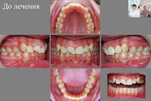 Прикус пациента с травмированными зубами , до брекетов