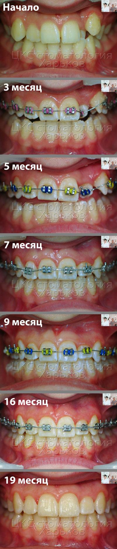 Семь фото на этапах лечения брекетами