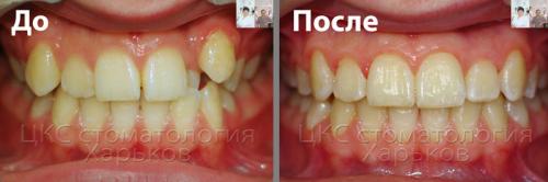 Фото прикуса пациента до и после брекетов