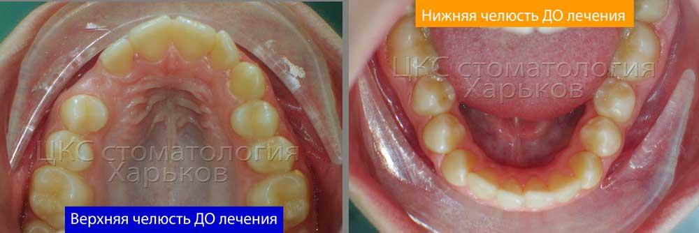 Неровные зубы, фото до лечения