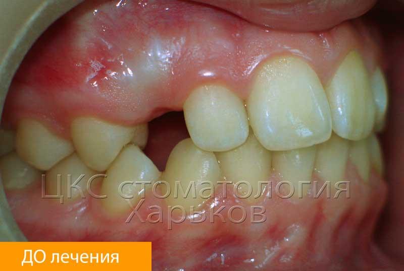 Ретенированный, дистопированный клык