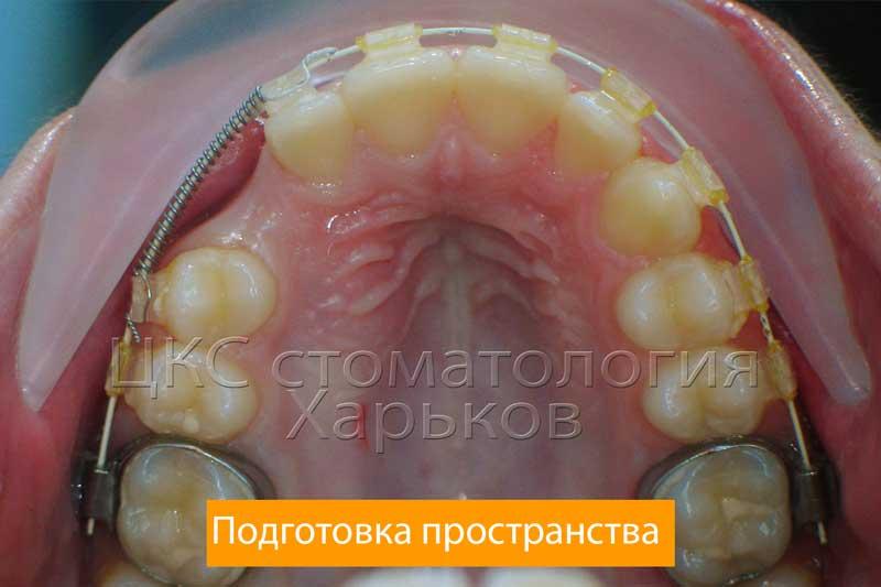 Начало лечения брекетами