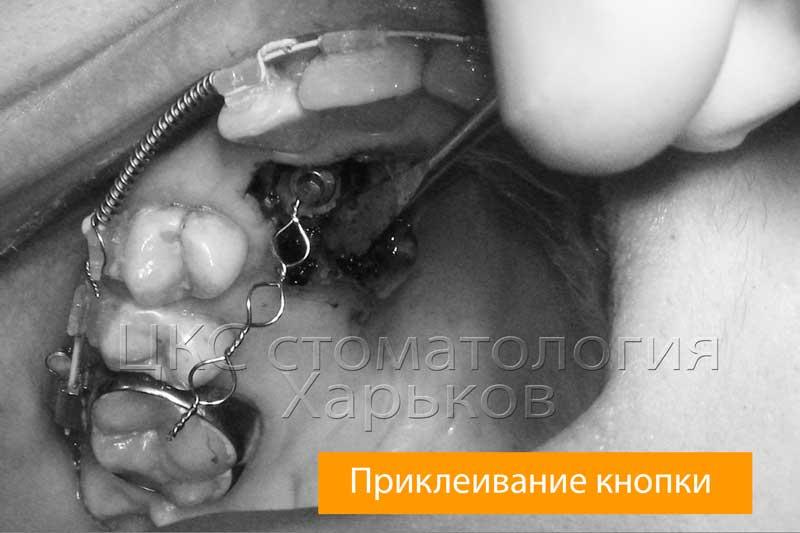 Операция открытия ретенированного зуба
