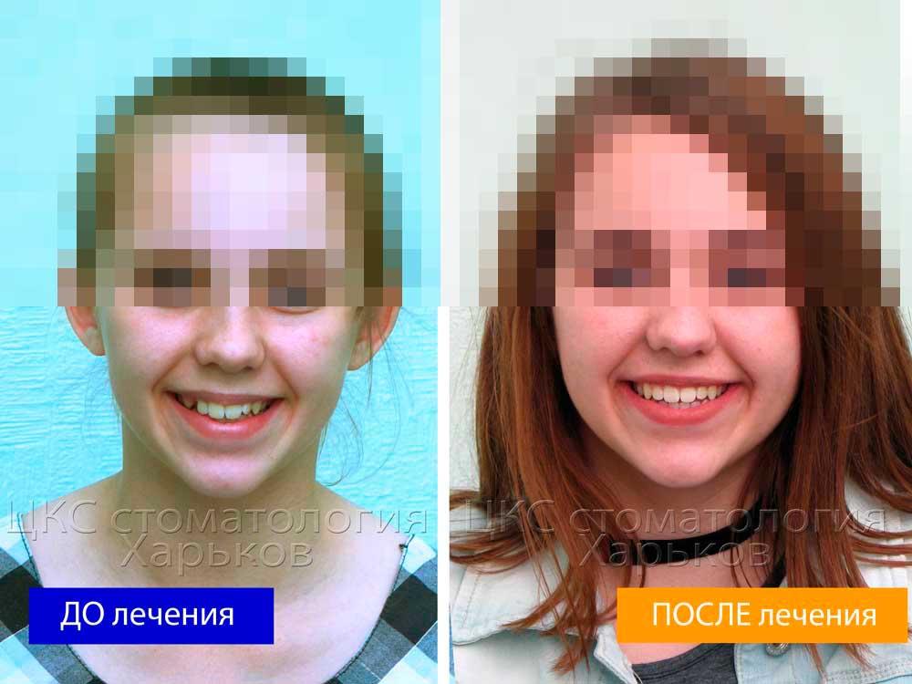 Улыбка ДО и ПОСЛЕ лечения керамическими брекетами