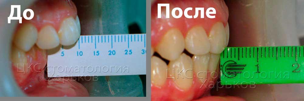 фронтальные зубы до и после