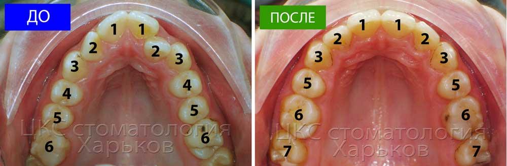 До и после удаления зубов