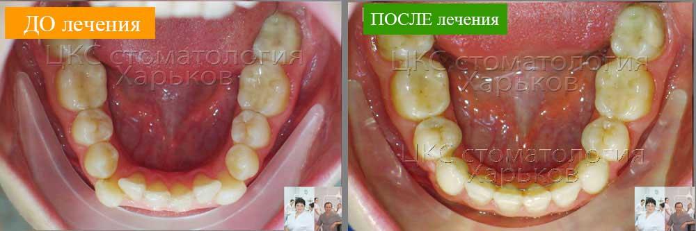 Нижняя челюсть ДО и ПОСЛЕ