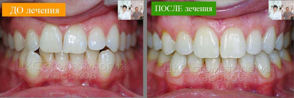 Фото зубов До и ПОСЛЕ