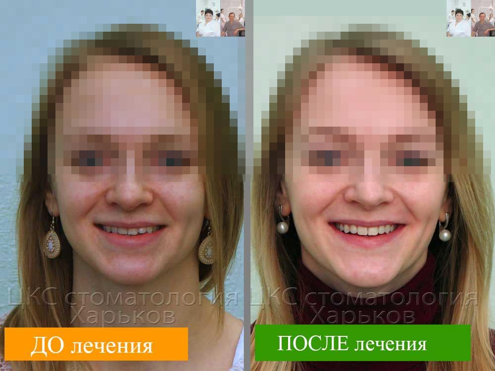 Улыбка ДО и ПОСЛЕ ортодонтического лечения