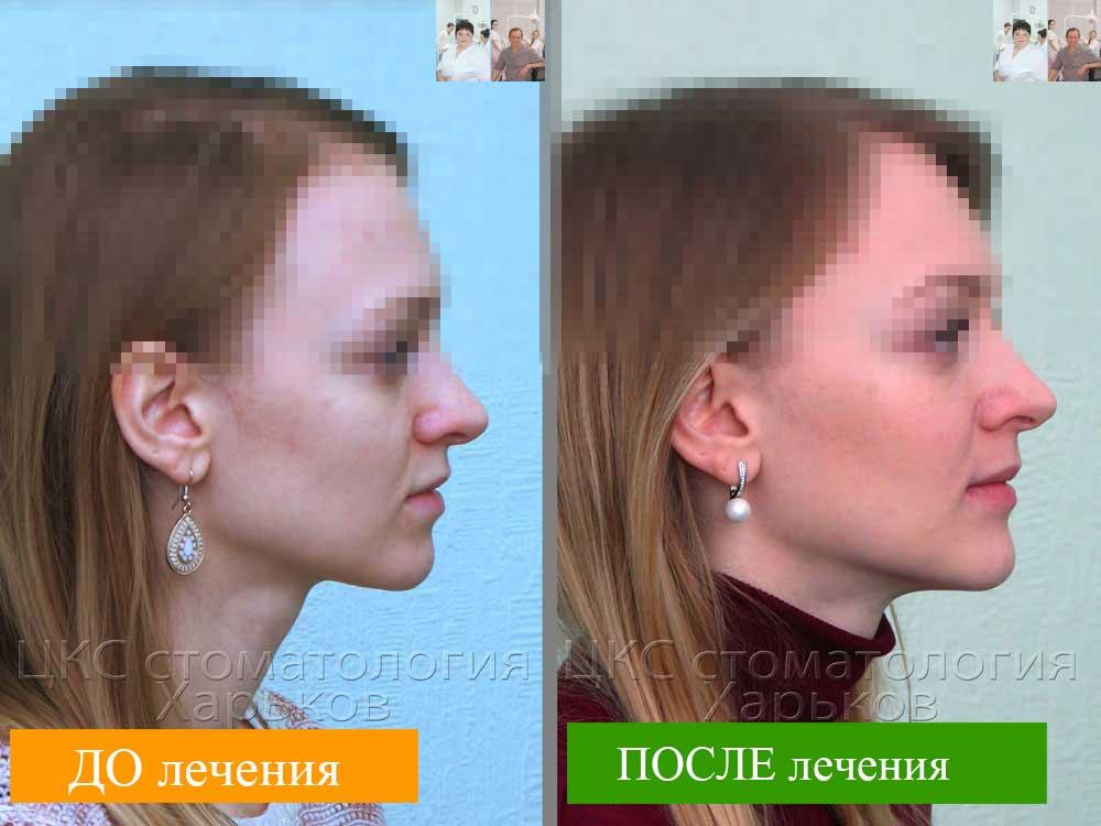 Профиль ДО и ПОСЛЕ брекетов