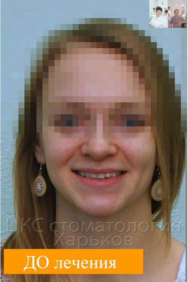 Улыбка ДО, смещение средней линии