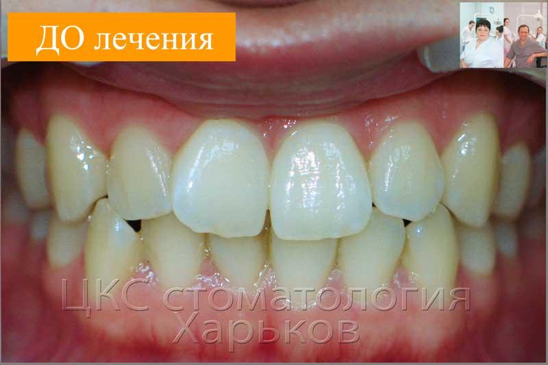 Кривые зубы