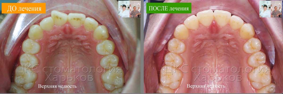Зубной ряд верхней челюсти ДО и ПОСЛЕ