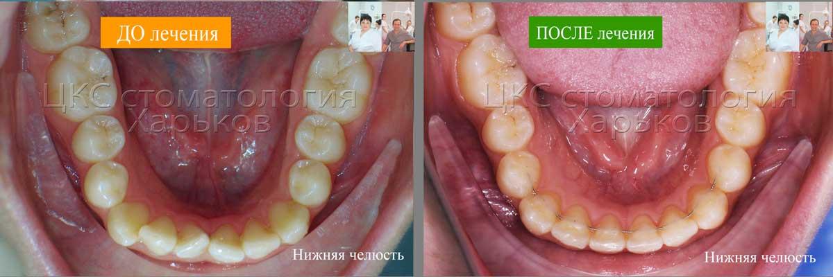 Нижняя челюсть ДО и ПОСЛЕ